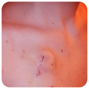 Mein Port.. unterhalb des Schlüsselbeins, falls es jemand nicht erkennen kann